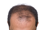 Treatment and application